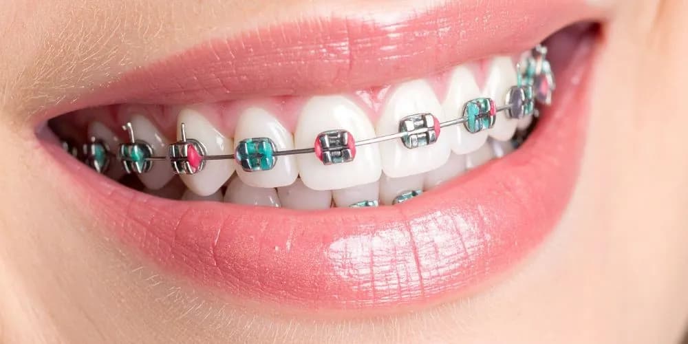Braces at Aurum Dental Clinic, Vadodara