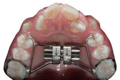 Clinician carrying out expansion appliances at Aurum Dental Clinic