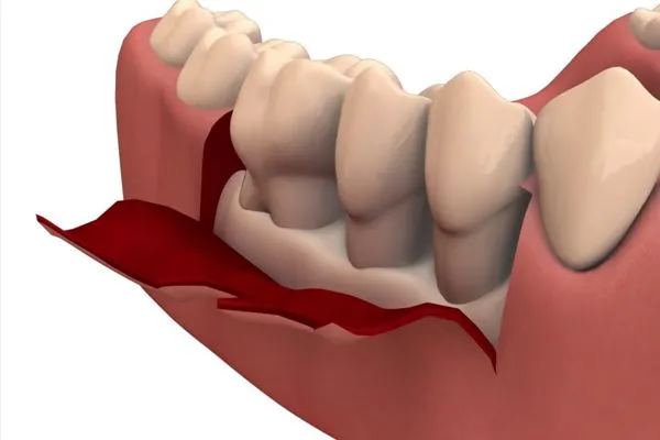 Clinician carrying out flap surgery at Aurum Dental Clinic