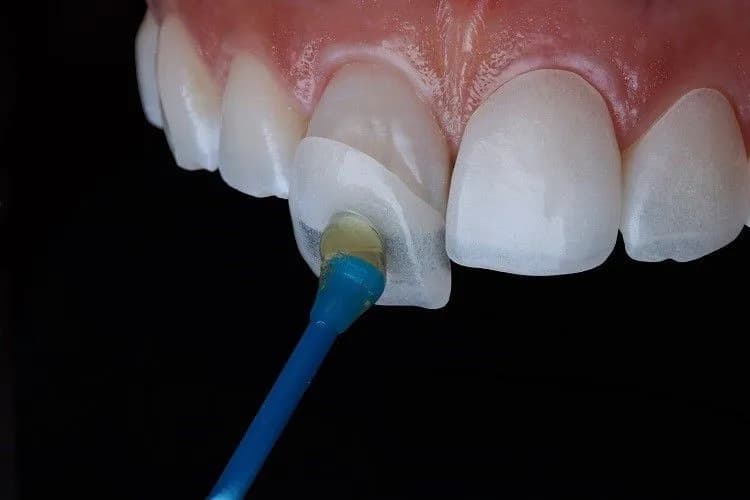 Clinician carrying out veneers at Aurum Dental Clinic