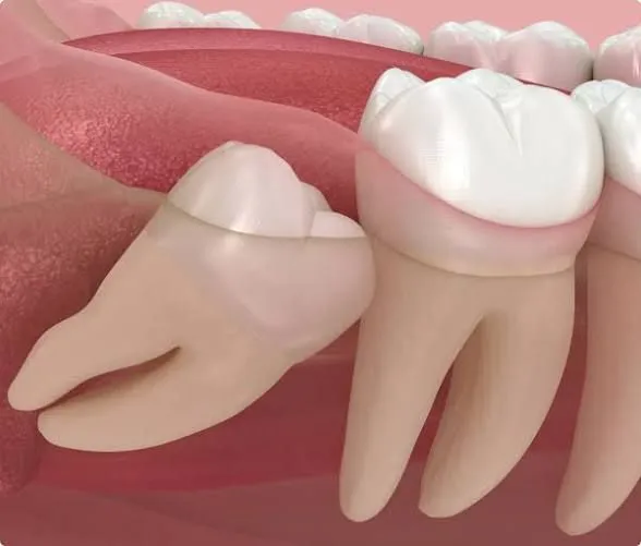 Clinician carrying out wisdom teeth removal at Aurum Dental Clinic