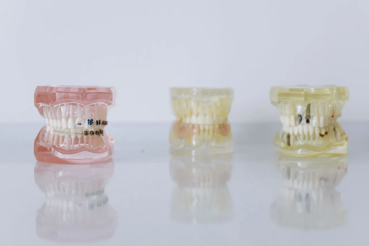 Mini Implants at Aurum Dental Clinic, Vadodara