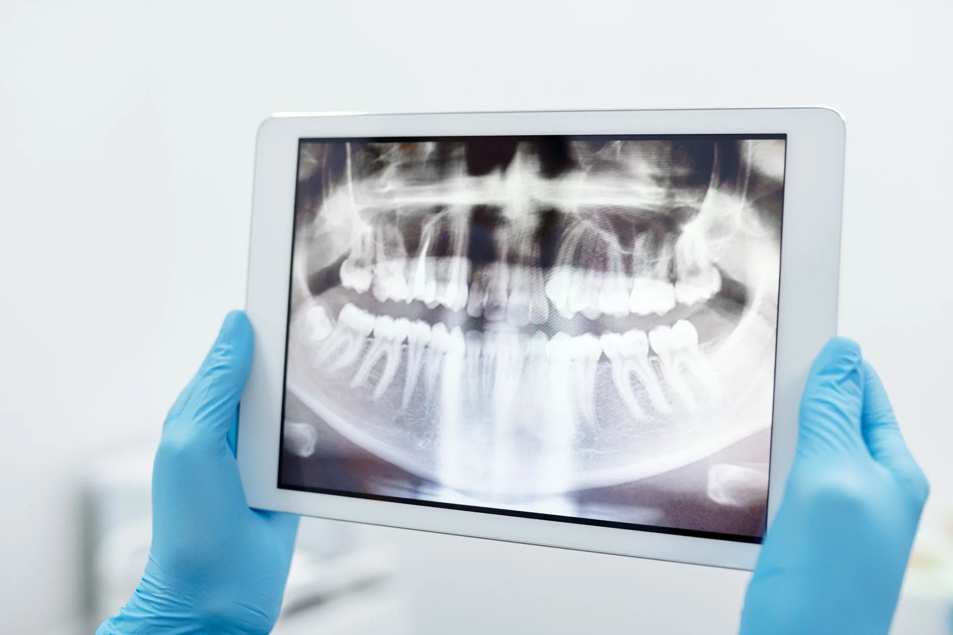 Implants at Aurum Dental Clinic, Vadodara